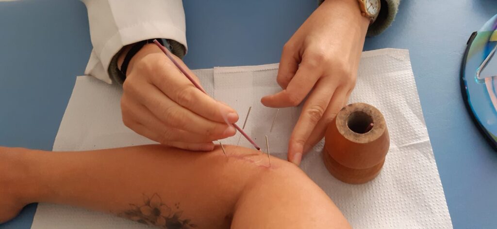 acupuntura